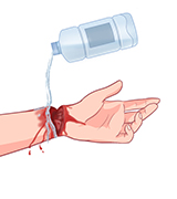 응급처치1